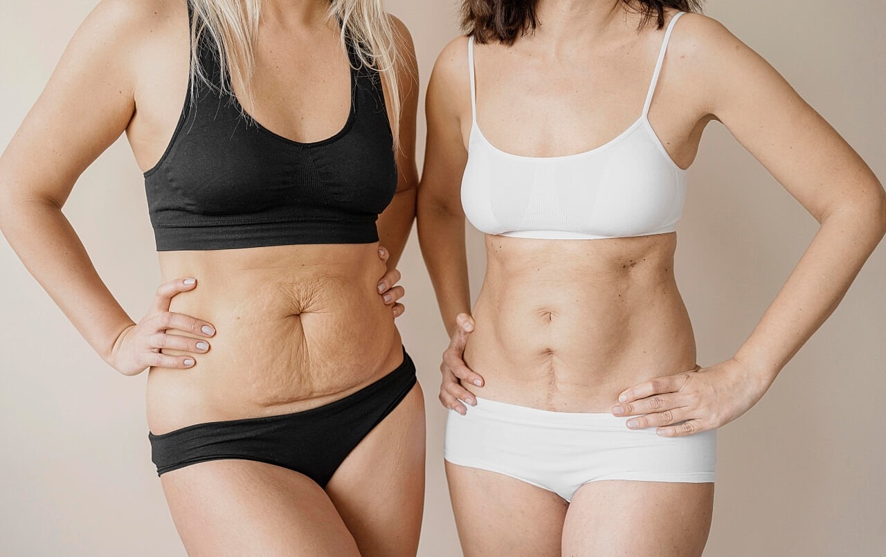 Tucson Liposuction models showcasing diverse body types and textures.